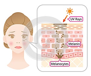 Skin mechanism of melanin and facial dark spots. Infographic illustration of woman face and skin layer. Beauty skin care concept photo